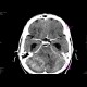 Cerebellar metastasis: CT - Computed tomography